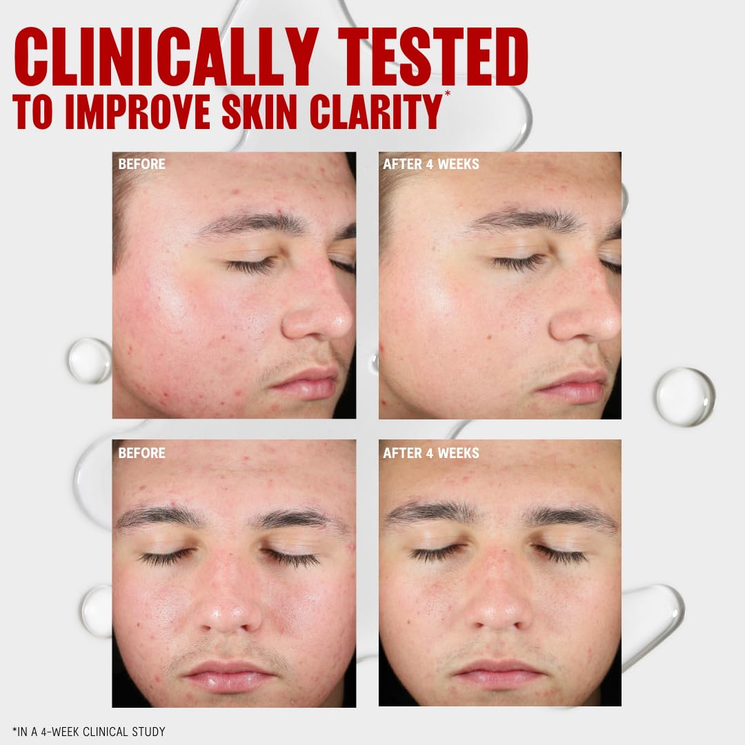 Salicylic Acid Pore Clearing Liquid Exfoliating Toner | speso tech